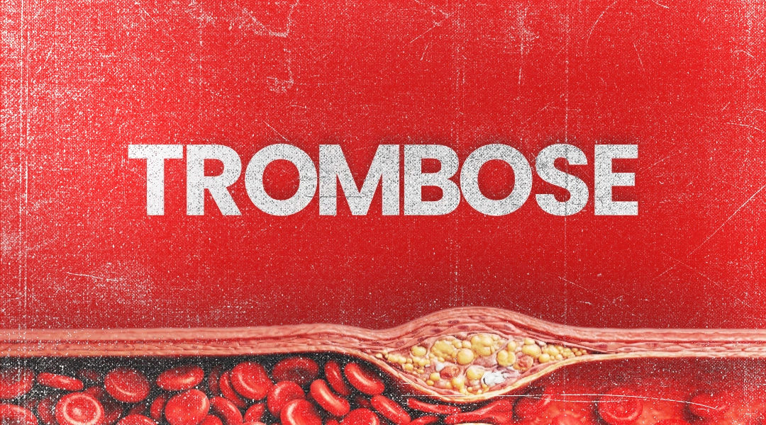 Trombose: informação ajuda a reconhecer fatores de risco e sinais de alerta